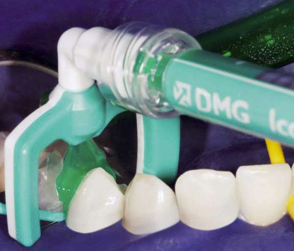600x512 Painless Cavity Fighters The Dmg Icon Fixes Teeth Without Numbing