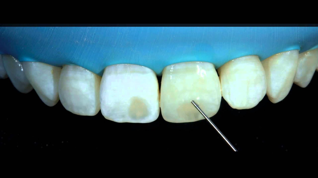 1280x720 Removal Of White Spots On Teeth With Dmg Icon