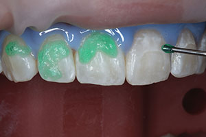 300x200 Treating Post Orthodontic White Spots A Conservative Resin