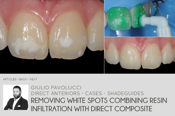 691x461 Dmg Dental Material On Twitter New Clinical Case