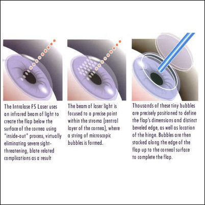 402x402 Icon Lasik In Denver, Colorado Announces The Introduction Of Intralase