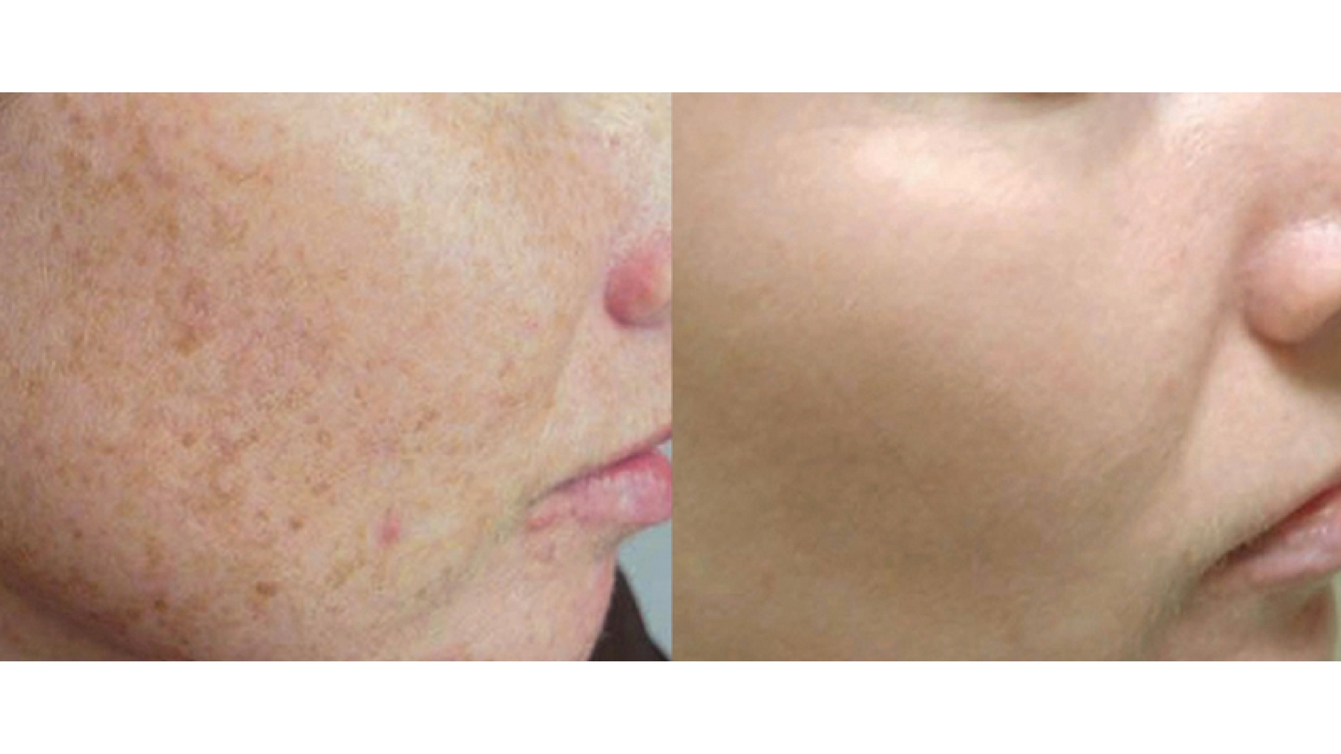 1920x1080 Icon Non Ablative Fractionation Laser Fraxel Newport