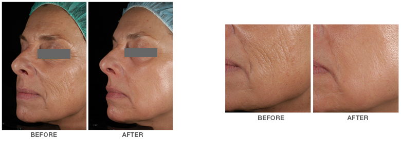 780x276 Palomar Icon Laser Tikkun Skin Care