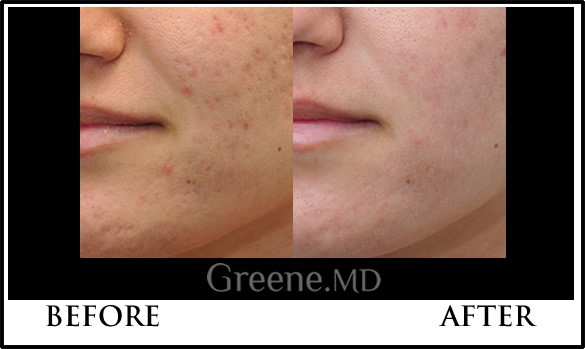 585x349 Palomar Lux Fraxel Laser Weston Improves Skin Texture