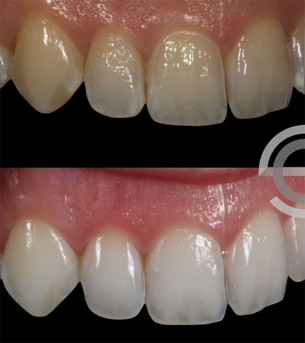 600x676 Icon White Spot Treatment Staines