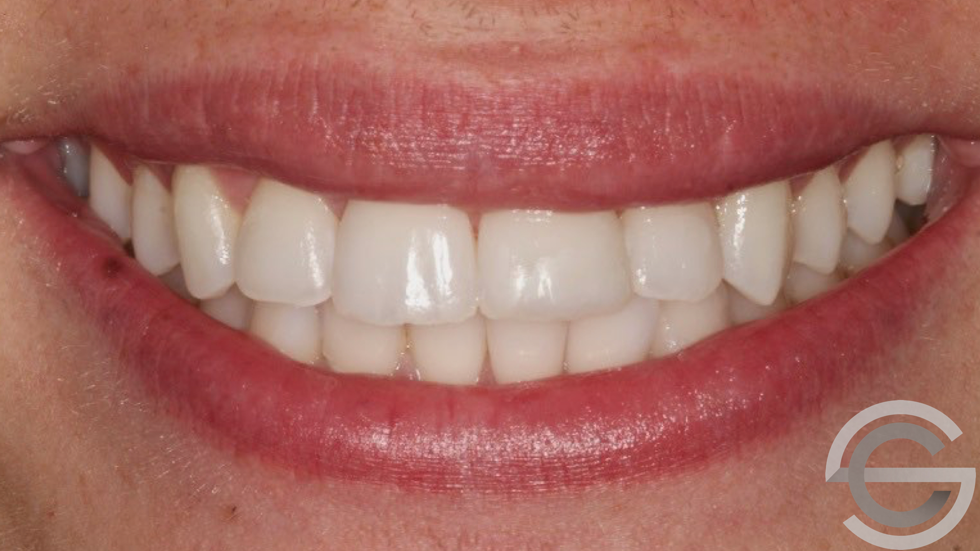 1920x1080 Tooth Whitening And Icon Treatment