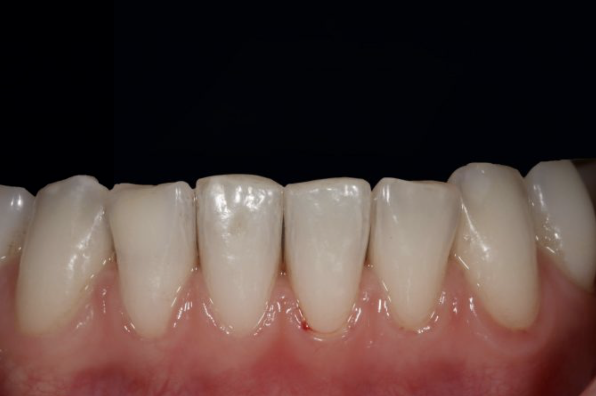 2010x1336 Brown And White Spots On Teeth Micro Invasive Treatment