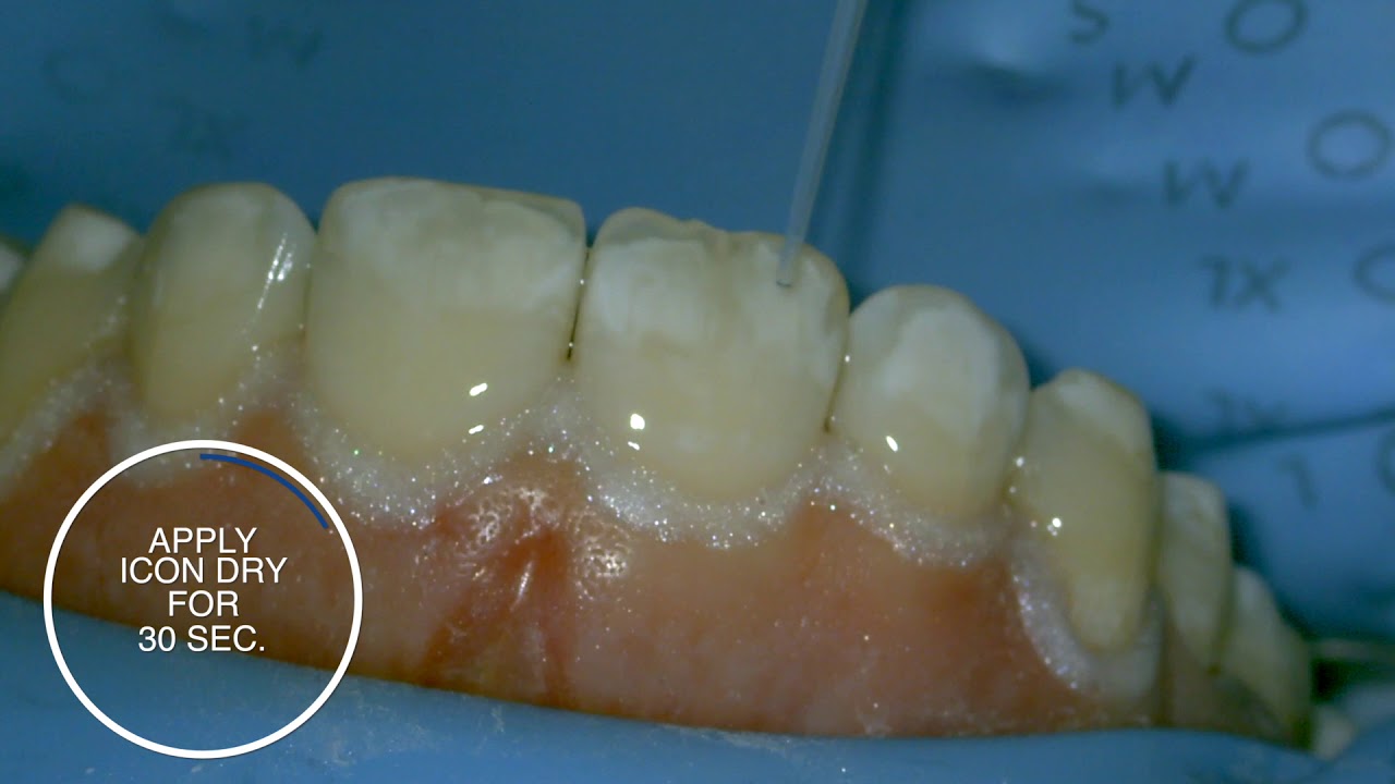 1280x720 White Spot Treatment Using Infiltration With Icon