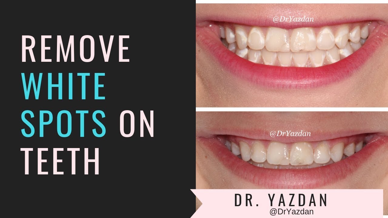1280x720 How To Remove White Spots On Teeth Icon Dental Treatment Dr