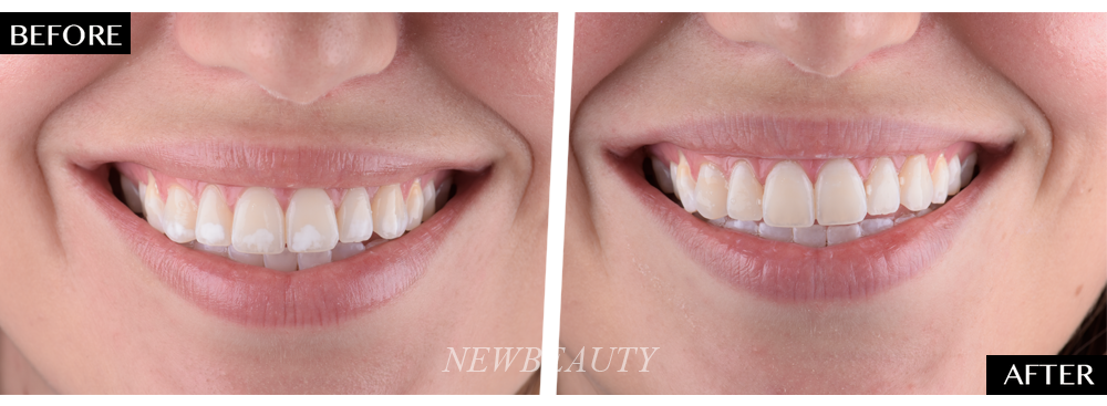 1000x367 Icon Dental Procedure Removes White Spots On Teeth