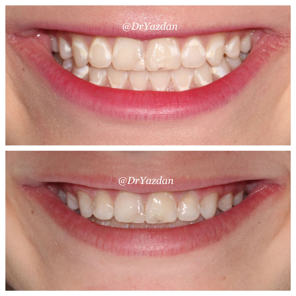 1000x1000 Icon White Spot Removal On Teeth Dr Desiree Yazdan Newport Beach