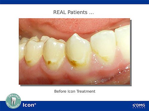 500x375 Icon Dental Treatment North York Summit Heights Dental