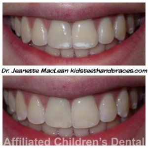 300x300 Icon Resin Infiltration