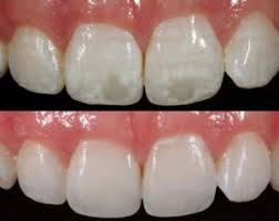 252x200 Icon Treatment White Spot Correction Advanced Services