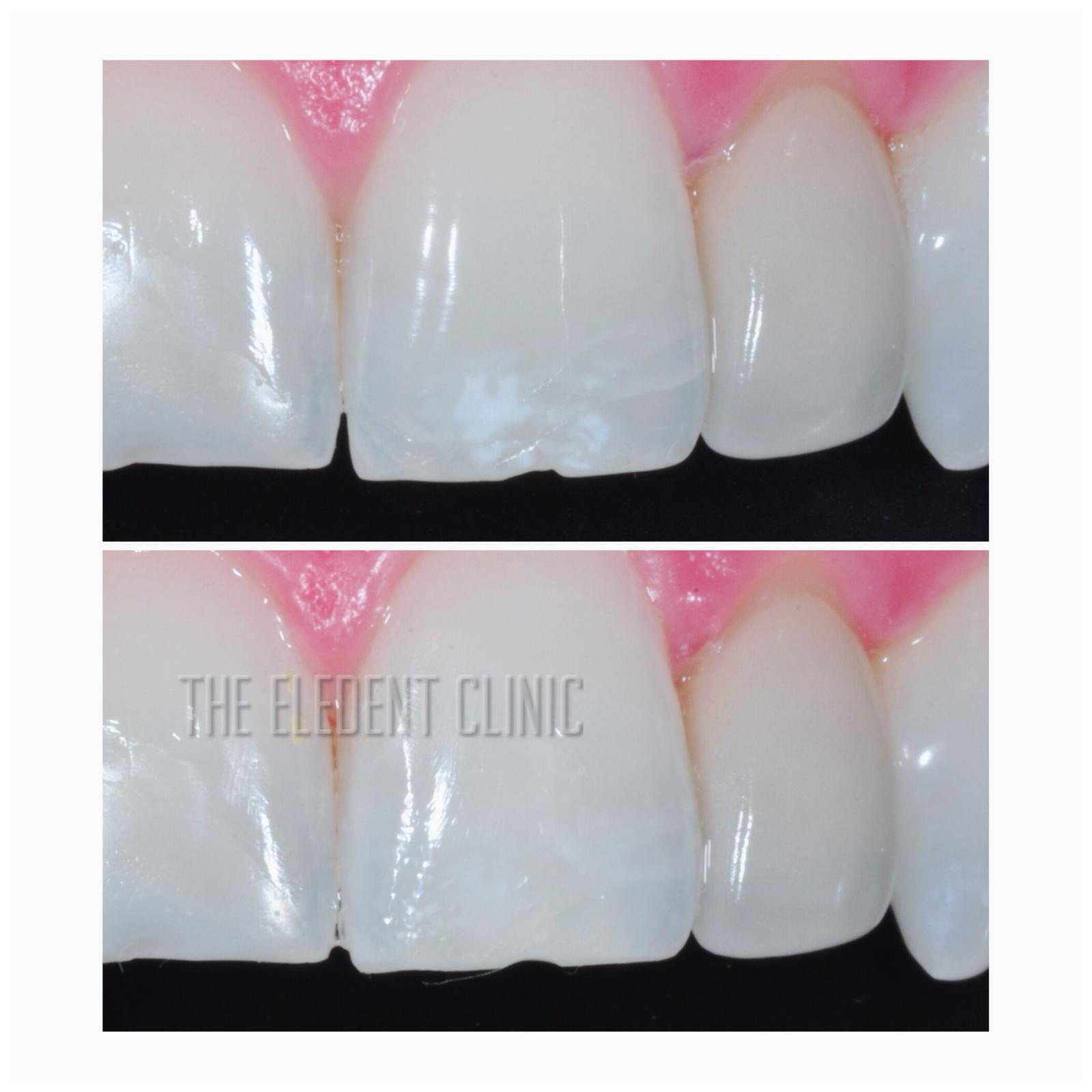 1600x1600 Icon White Spot Treatment