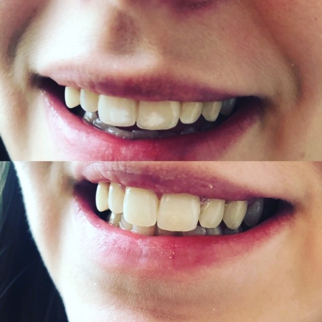 640x640 Icon White Spot Treatment