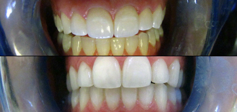 800x380 Photos After Teeth Whitening Treatment Spring Creek Dental