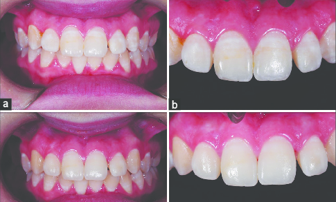 485x292 A And B Pt Before Treatment