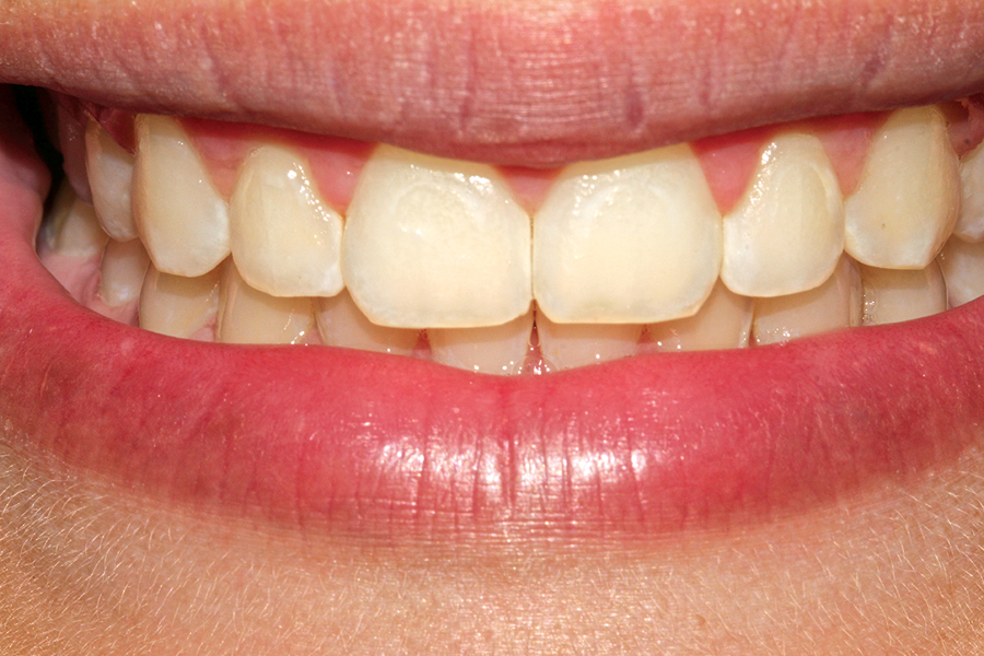 900x600 Icon Treatment Of Post Orthodontic White Spot Lesions