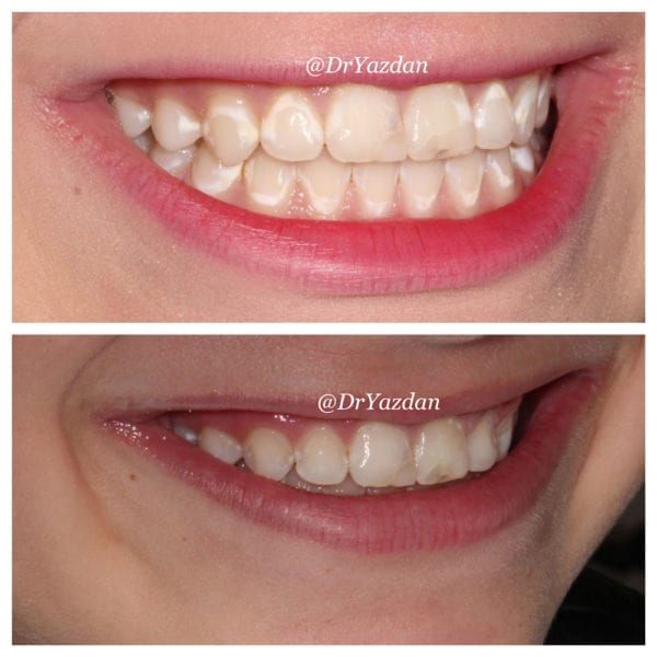 600x600 Icon White Spot Removal On Teeth Dr Desiree Yazdan Newport Beach