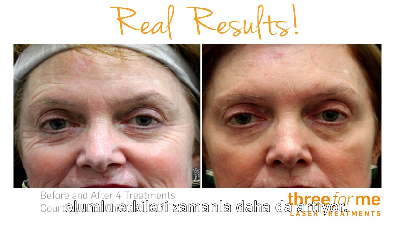 1280x720 Icon Lazer Cilt