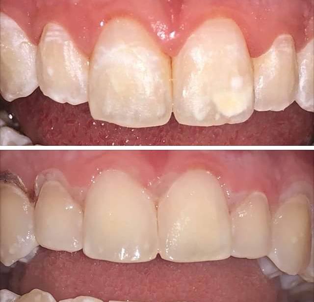 640x615 Caries Treatment Dentist In Muscatine, Ia