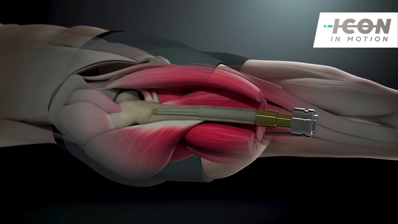 1280x720 Icon In Motion Osseointegration Improving Amputee Life Quality