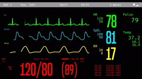 480x268 Monitoring Of Patient's Condition, Vital Signs On Icu Monitor